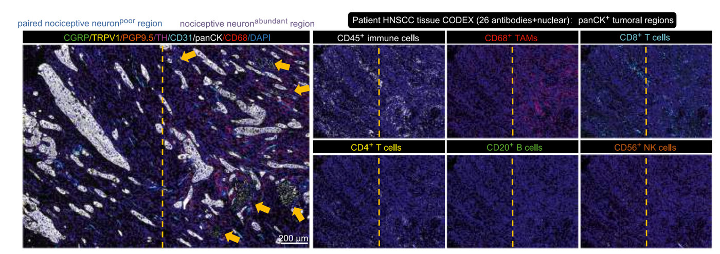 HNSCC 患者组织 CODEX 多重成像：CGRP/TRPV1/PGP9.5 神经元与 CD45/CD68/CD8/CD4/CD20/CD56 免疫细胞空间分布
